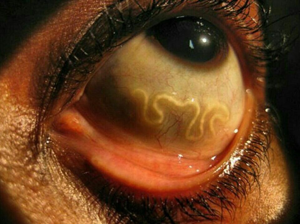 parazitai žmogaus akyje